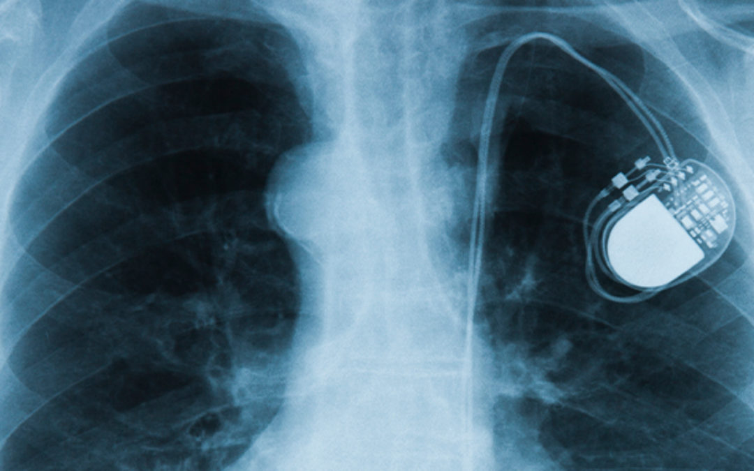 Pacemakers and Other Implanted Devices at Risk of Hacking, Warns FDA